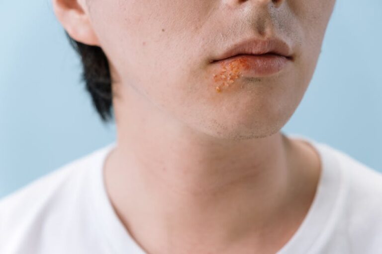 A close-up image of a person's lips showing a cold sore on the lower lip area.